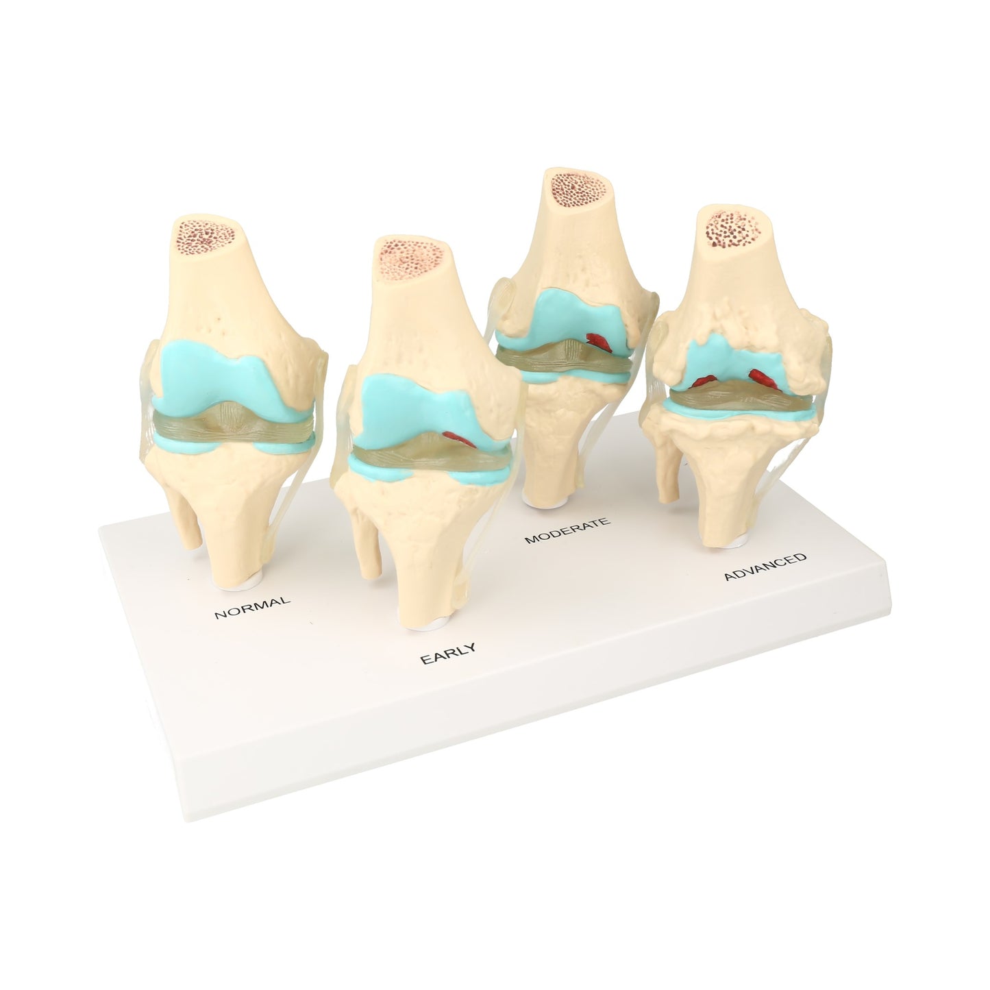 modelo anatómico de la articulación de la rodilla que muestra las cuatro etapas de la osteoartritis.